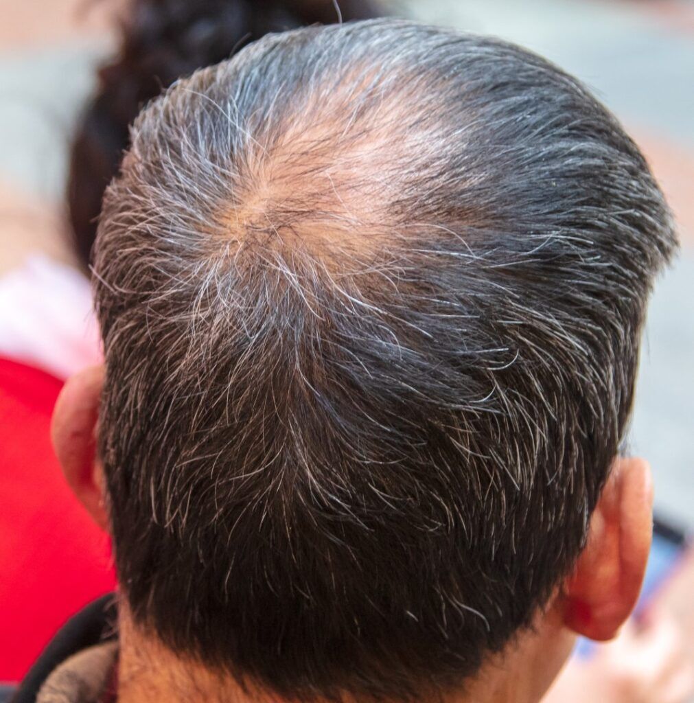 Effective Male Pattern Baldness Treatment In Ogden Utah
